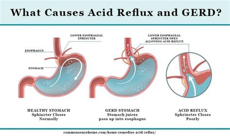 Pin On Acid Reflux Home Remedies | Free Download Nude Photo Gallery