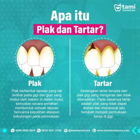 Apa Itu Plak dan Tartar ? – Tami Dental Care – Klinik Dokter Gigi Bandung Bojongsoang Cimahi ...