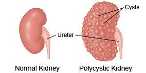 Autosomal Dominant Polycystic Kidney Disease - What You Need to Know