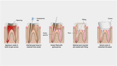 Root Canal | the dental clinic