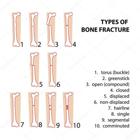 5 Different Types Of Fractures