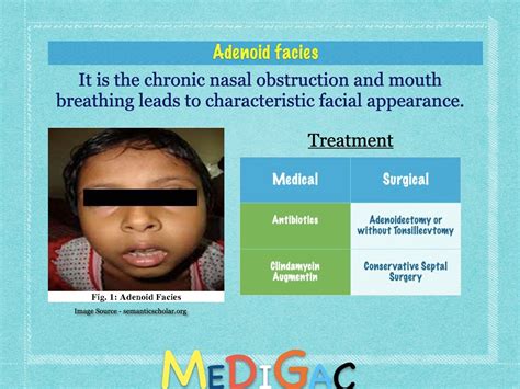 Adenoid Facies Features