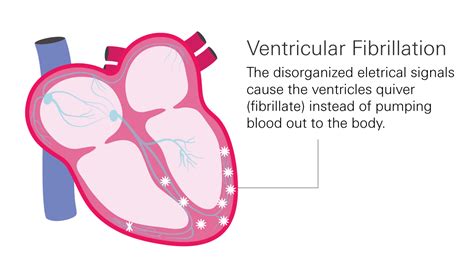 Ventricular Fibrillation