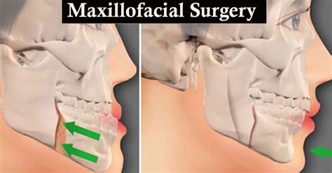 Maxillofacial Surgery in India - Sky Dental Care Hospital