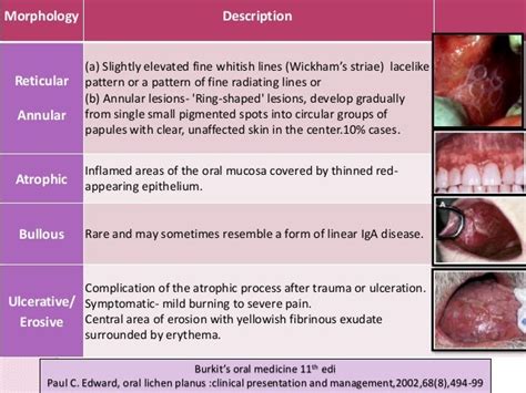 Oral Lichen Planus