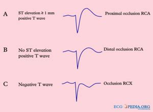 Inferior MI - ECGpedia