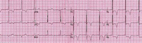 Hypertrophic cardiomyopathy diagnostic testing - wikidoc