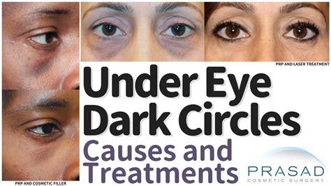 What Causes Dark Under Eyes - Infoupdate.org