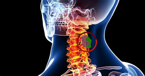 Spinal Tumors - Atlanta, GA - Spine Surgery