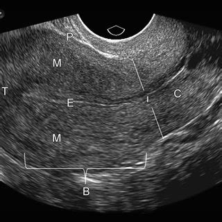 Female Pelvic Anatomy Ultrasound : Normal gynaecological ultrasound - transvaginal | Image ...