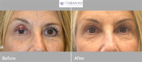 Eyelid Chalazion Surgery Before and After Gallery | Taban MD