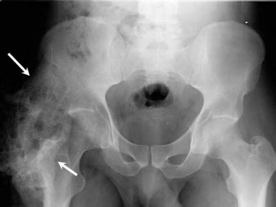 Heterotopic Ossification - Physiopedia