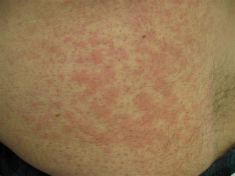 Dust Mite Allergy Symptoms Rash