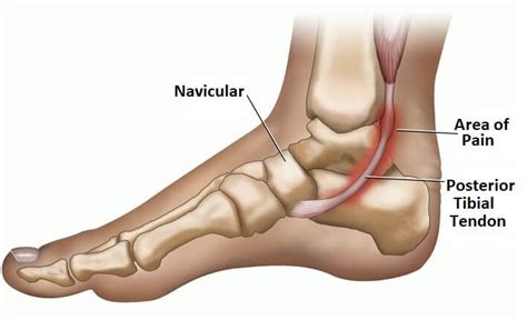 Posterior Tibial Tendonitis - Foot Pain Explored