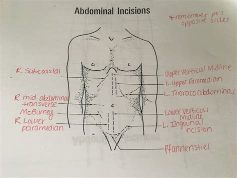 Abdominal Incisions Diagram | Quizlet