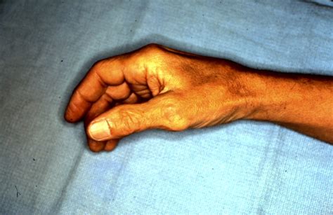 RCL Reconstruction Thumb MPJ | The Hand Treatment Center - New Jersey/New York Hand Surgeon