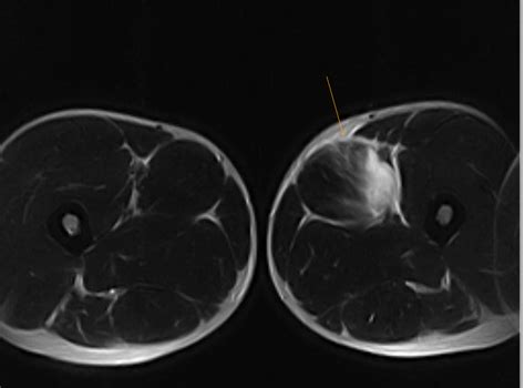 Adductor Injury -MRI - Sumer's Radiology Blog