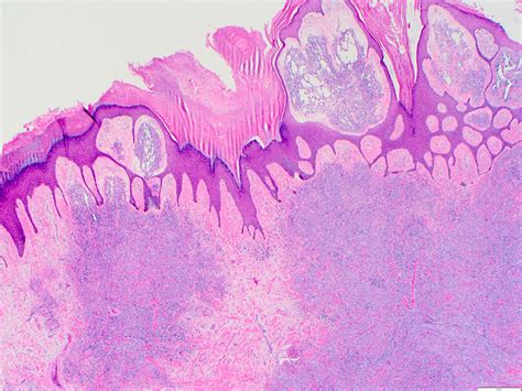 Epithelioid Angiosarcoma