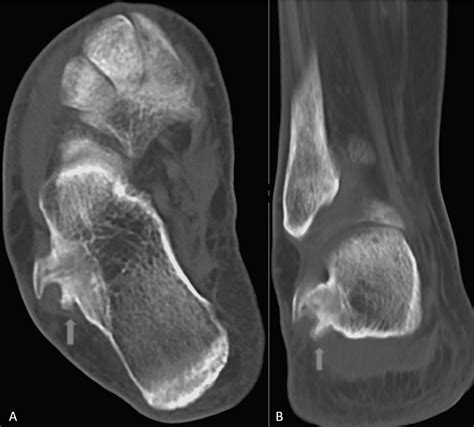 Cureus | Enlarged Reactional Periostitis of the Peroneal Tubercle Mimicking Osteochondromatosis ...