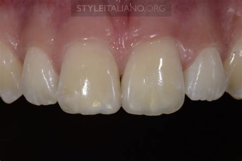 The Fountain of Youth: colour and incisal anatomy - Styleitaliano.org