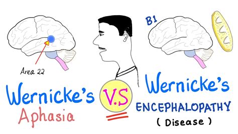 Broca's Area Vs Wernicke's Area,Speech and Language Disorders