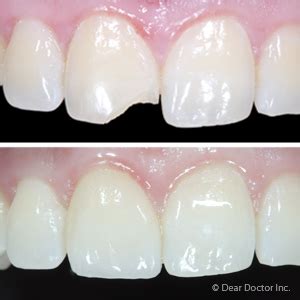 Bonding with Composite Resins Ideal for Restoring Chipped Teeth