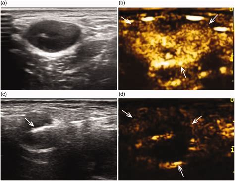 A 23-year-old female patient with cervical tuberculous lymphadenitis ...