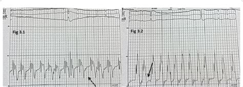 Cardiac catheterization. Figure 3.1: right atrial pressure waveform ...