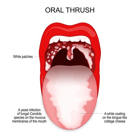 How To Treat Thrush In Adults Sale | www.cumberland.org