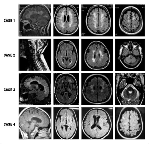 Ms Mri Brain Scan Results