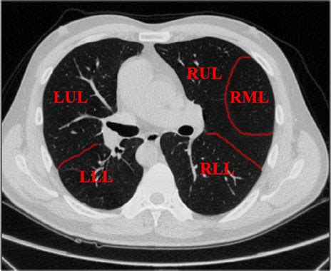 Frontiers | Edge-enhancement cascaded network for lung lobe segmentation based on CT images