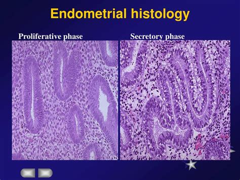 Endometrial Cancer Histology