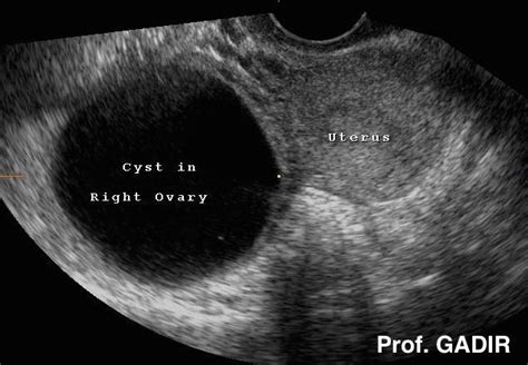 Issue 11: See the big picture when it comes to imaging for ovarian cysts