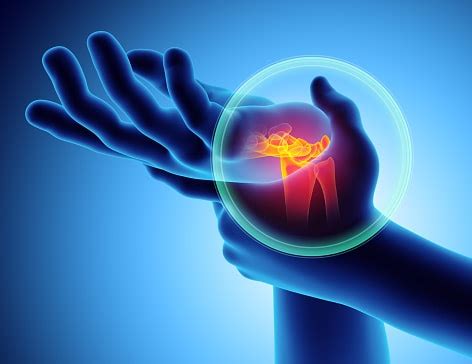 Bone Spur in Hand, Wrist, and Fingers: Causes, Symptoms, and Treatment