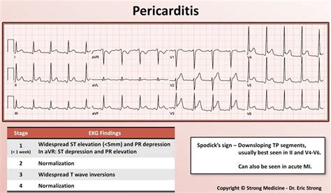 Constrictive Pericarditis Ecg