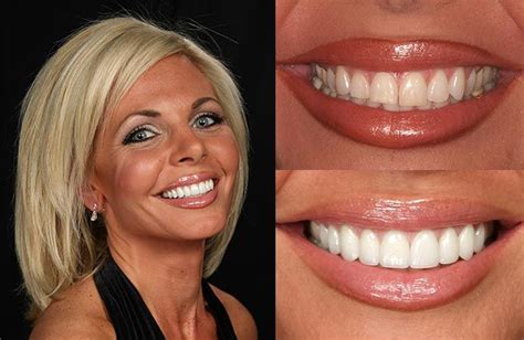 Pin by Anna McCallum/Phillips on Veneers | Hair implants, Veneers teeth ...