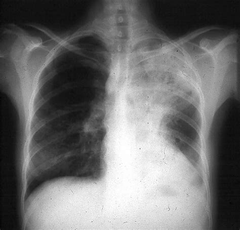 Blastomycosis in humans causes, symptoms, diagnosis and treatment