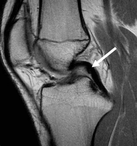 PCL Injury | Posterior Cruciate Ligament Tear | Knee Specialist | Minnesota