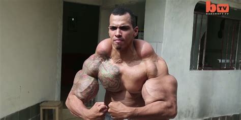 Guy Who Wanted To Be A Real-Life Hulk Almost Had To Have Arms Amputated ...