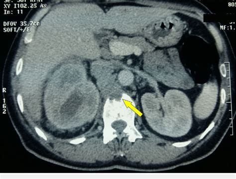 Para Aortic Lymphadenopathy Differential Diagnosis