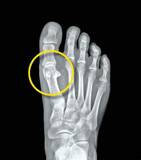 Dr. Yoshidas' Foot Orthotic Center: Sesamoid Foot Pain - Orthotic Accommodation