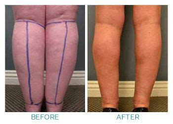 Lipedema liposuction - Before and After | Lipedema, Liposuction, Lymphedema