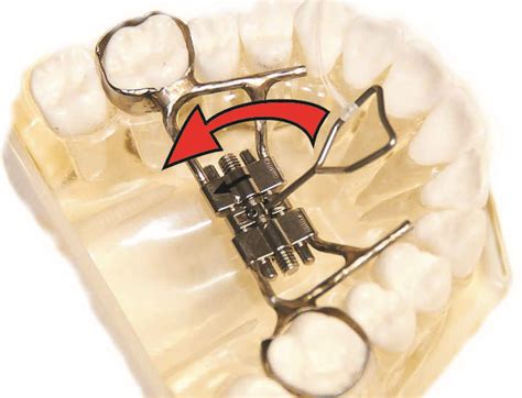 What is a Rapid Palatal Expander? | Ask an Orthodontist.com