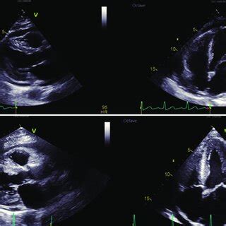 (a) Left ventricular ejection fraction 55%. Wall thickness moderately... | Download Scientific ...