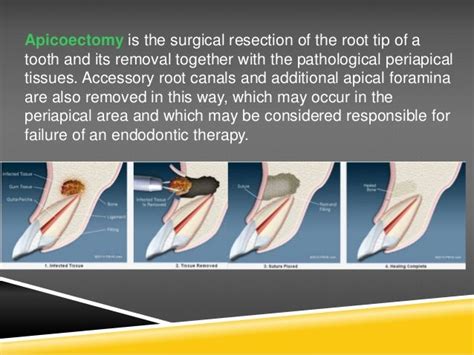 apicoectomy