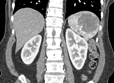 Splenic Hemangioma - Spleen Case Studies - CTisus CT Scanning