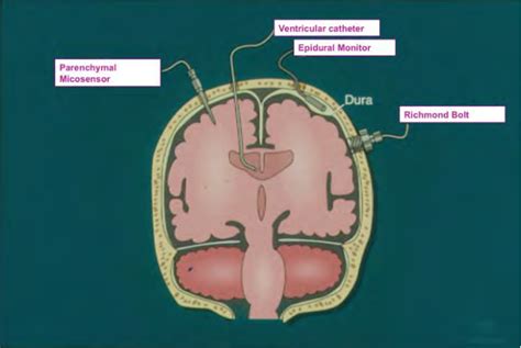 Figure 1 from Management of Increased Intracranial Pressure | Semantic Scholar