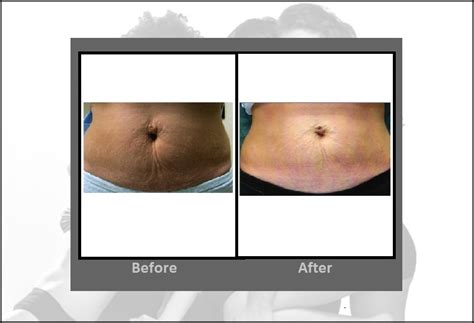 Titan Skin Tightening Procedure | Hartford CT