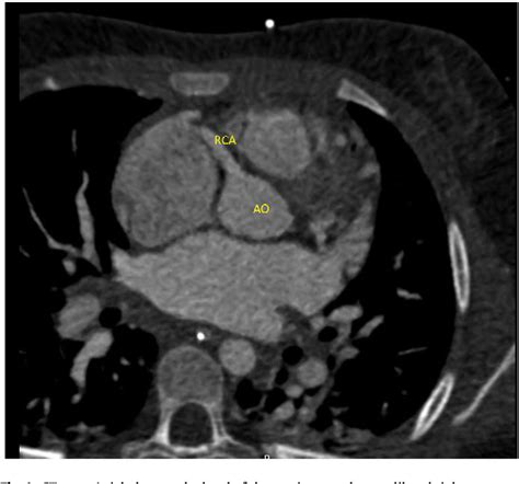 Figure 1 from ALCAPA syndrome: A rare etiology of cardiac arrest in a ...