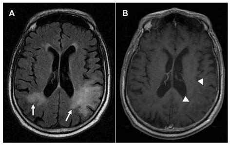 Brain MRI shows multiple PML lesions A Fluid attenuation inversion... | Download Scientific Diagram